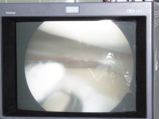 Travel - Bolivia - Knee Operation